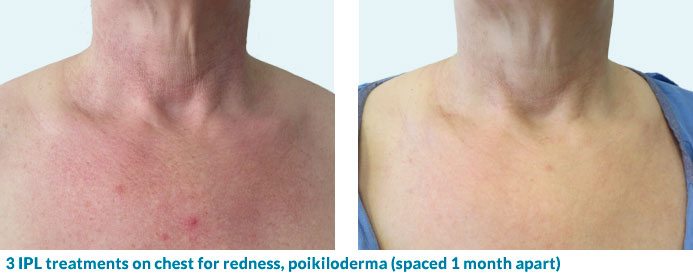 IPL for chest redness, poikiloderma