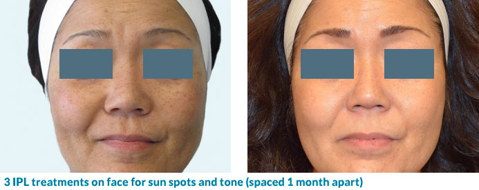 IPL for sun spots, tone