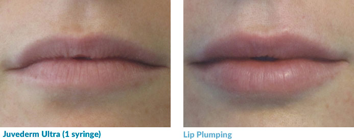 Juvederm treatment for Lip Plumping