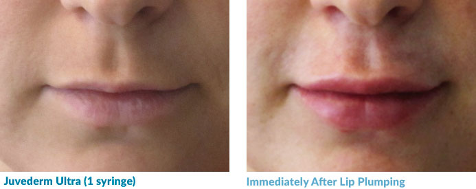 Juvederm treatment for Lip Plumping