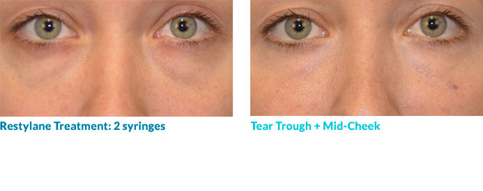 Botox in your 20s—and often 30s—is often able to completely smooth out the lines because these “dynamic” lines have not yet become “static,” or present at rest. Remember: neuromodulators work by relaxing the muscles that contribute to this lines so once the lines become static, relaxing the muscle may not completely remove the line.