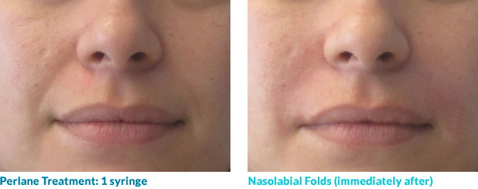Botox in your 20s—and often 30s—is often able to completely smooth out the lines because these “dynamic” lines have not yet become “static,” or present at rest. Remember: neuromodulators work by relaxing the muscles that contribute to this lines so once the lines become static, relaxing the muscle may not completely remove the line.