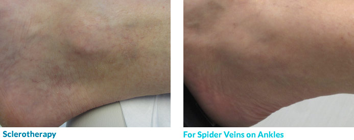 Sclerotherapy treatment for spider veins on ankles