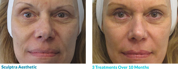 10 Months Following 3 Sculptra Treatments