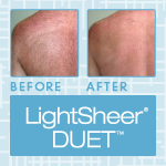 LightSheer DUET