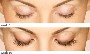 Latisse Before + After